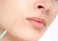 鼻唇沟填充