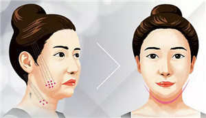 打瘦脸针,瘦脸针