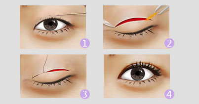 安徽合肥维多利亚整形外科医院割双眼皮